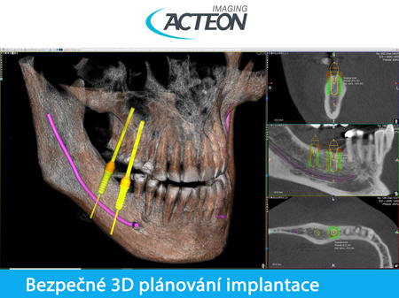 CBCT 3D bezpečné 3D plánování implantace