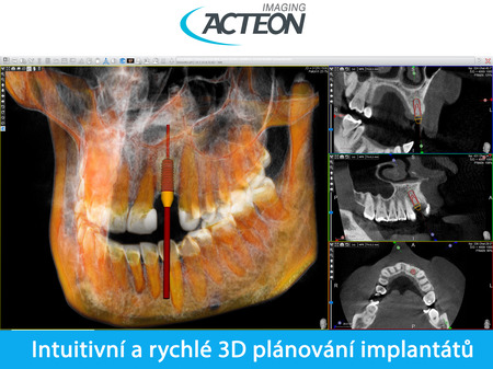 CBCT 3D plánování implantátů3