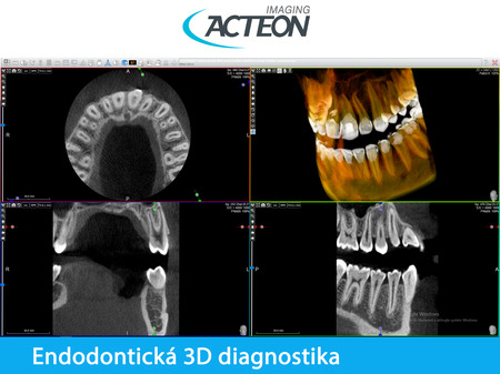 CBCT 3D endodontická diagnostika7