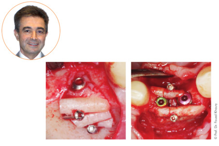 Meisinger Micro Screw Plus System (kostní šrouby a trepany) by Prof. Dr. Fouad Khoury, BMSPL