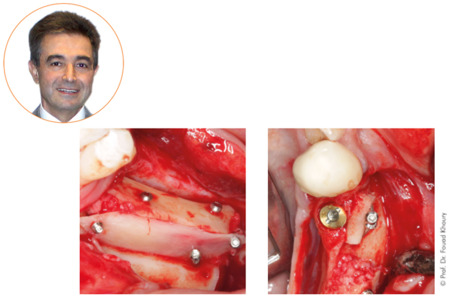 MEISINGER Micro Screw System (BMS00) by Prof. Dr. Khoury